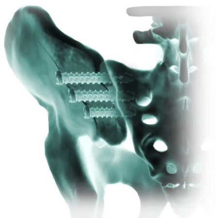 Why the Sacroiliac Joint Fusion market will reach US$ 360..