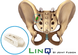 Linq Sacroiliac Joint Fusion System Spinemarketgroup